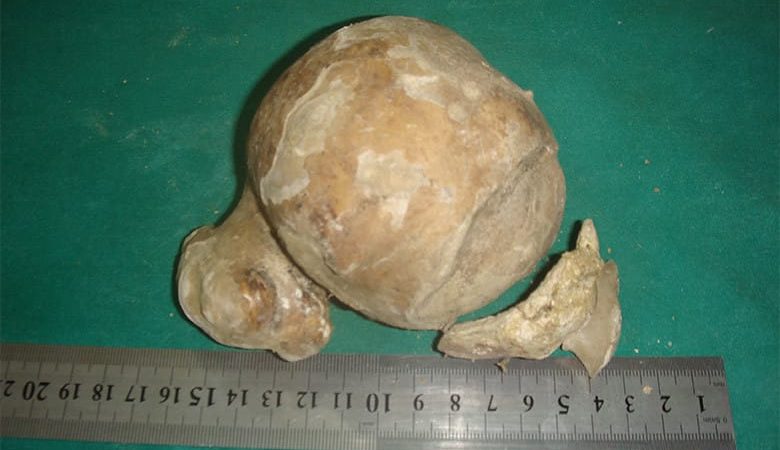 The biggest kidney stone